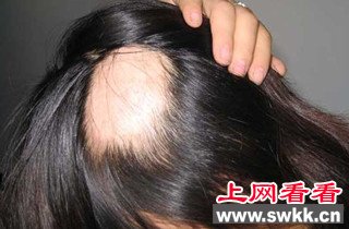 头发斑秃的原因