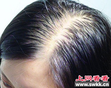 头发斑秃的原因