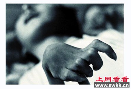 水俣病症状