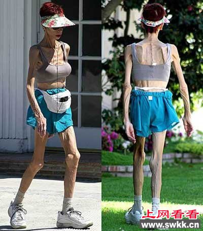 世界上最瘦的女孩