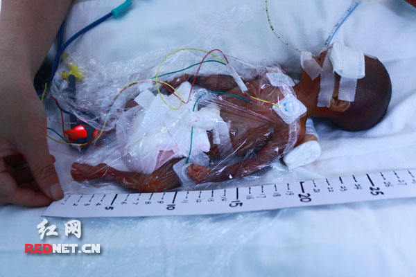 被称为湖南出生的体重最轻早产儿“小小”（化名）浑身包裹着保鲜膜躺在重症监护室中。