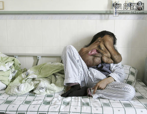 2008年1月5日,湖南象面人黄春才在做第二次手术前的模样。